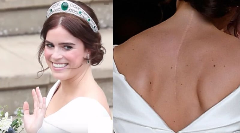 Princess Eugenie Scoliosis Scar in Wedding Gown - Royal Family News