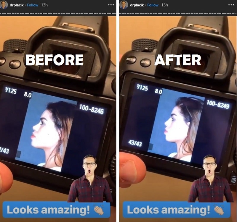 90 Day Fiance - Fernanda Flores - Nose Job - Before and After