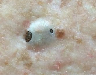 Dr. Pimple Popper: Sandra Lee