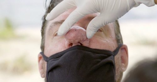 Dr. Pimple Popper: Stephen